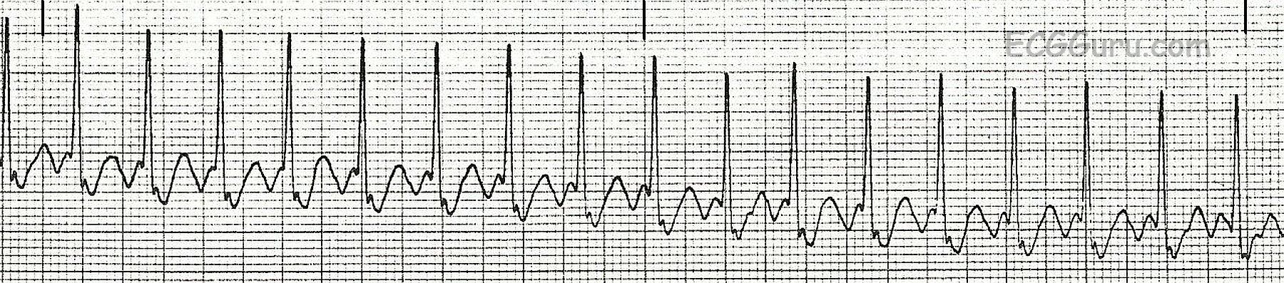 Ecg Basics Atrial Flutter With 21 Conduction Ratio Rhythm Strip